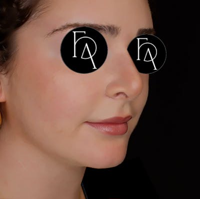 Chin Augmentation Before & After Gallery - Patient 356998 - Image 2