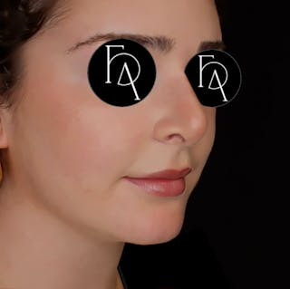 Chin Augmentation Before & After Gallery - Patient 356998 - Image 4