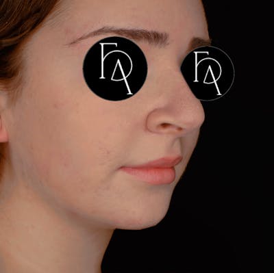Chin Augmentation Before & After Gallery - Patient 356998 - Image 1