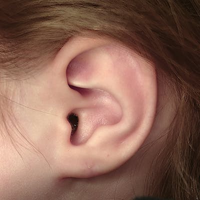 Earlobe Repair Before & After Gallery - Patient 247427 - Image 2