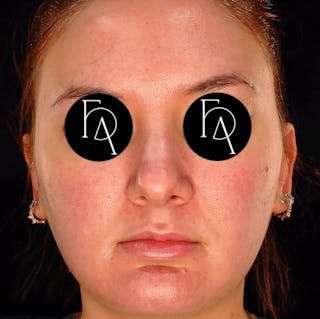 Buccal Fat Removal Before & After Gallery - Patient 671142 - Image 4