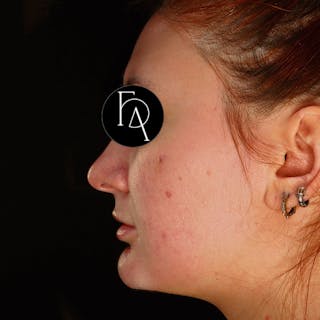 Buccal Fat Removal Before & After Gallery - Patient 671142 - Image 2
