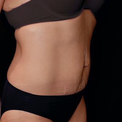 Tummy Tuck Before & After Gallery - Patient 174882 - Image 1