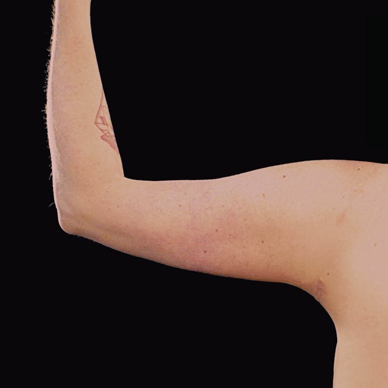 Short Scar Arm Lift Before & After Gallery - Patient 944136 - Image 2