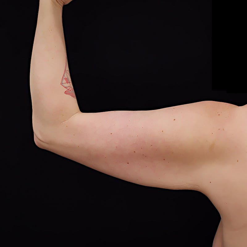 Short Scar Arm Lift Before & After Gallery - Patient 944136 - Image 1