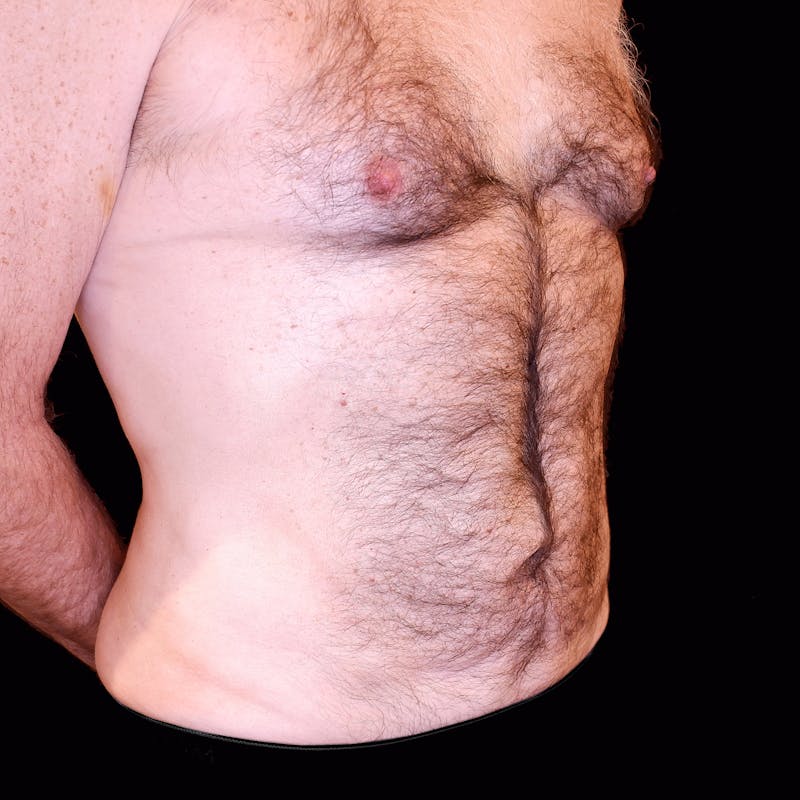 Abdominal Liposuction Before & After Gallery - Patient 366136 - Image 4