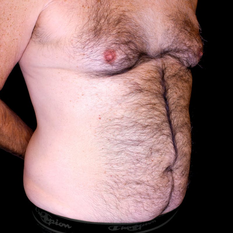 Abdominal Liposuction Before & After Gallery - Patient 366136 - Image 3