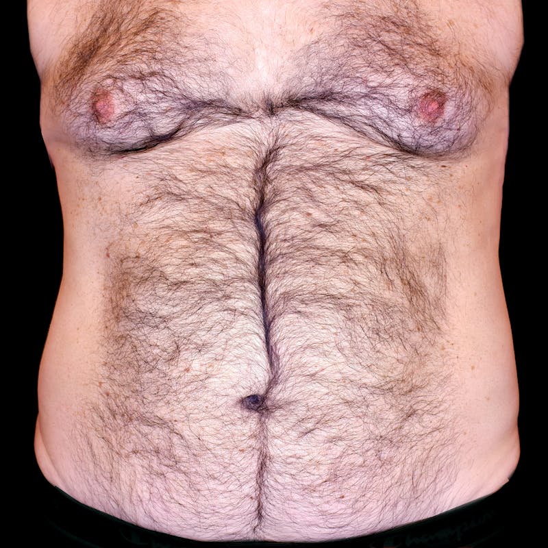 Abdominal Liposuction Before & After Gallery - Patient 366136 - Image 1