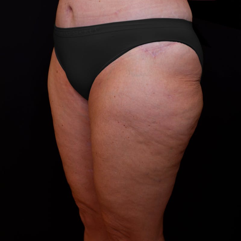 Thigh Lift Before & After Gallery - Patient 353222 - Image 4