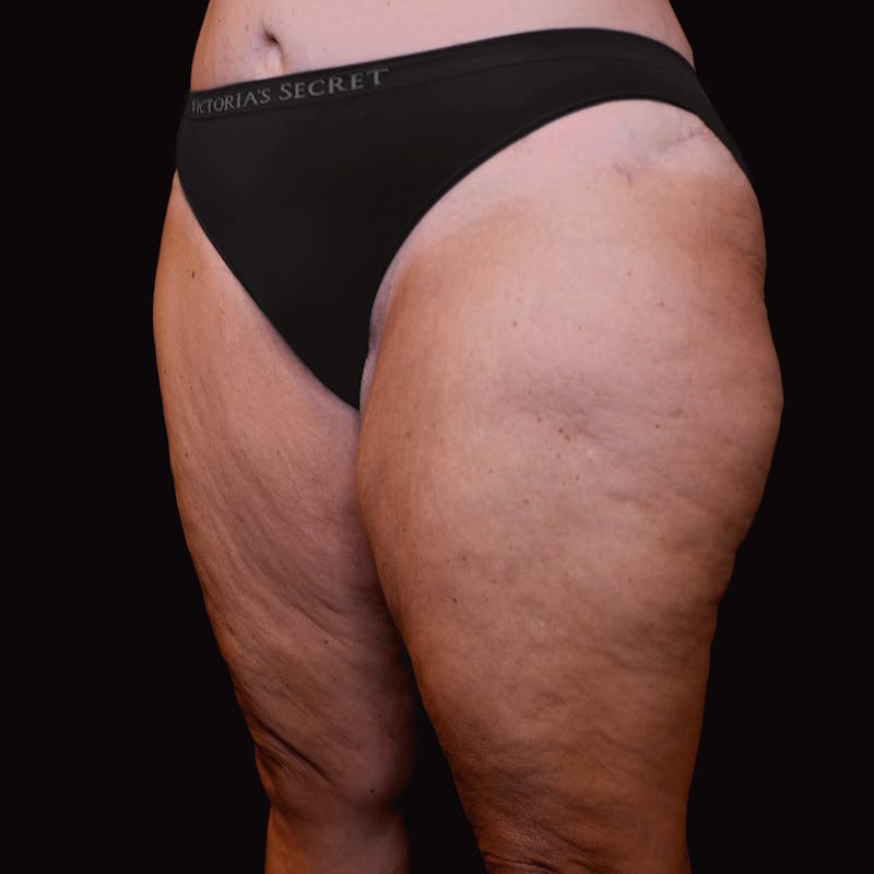 Thigh Lift Before & After Gallery - Patient 353222 - Image 3