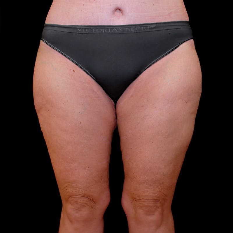 Thigh Lift Before & After Gallery - Patient 353222 - Image 2
