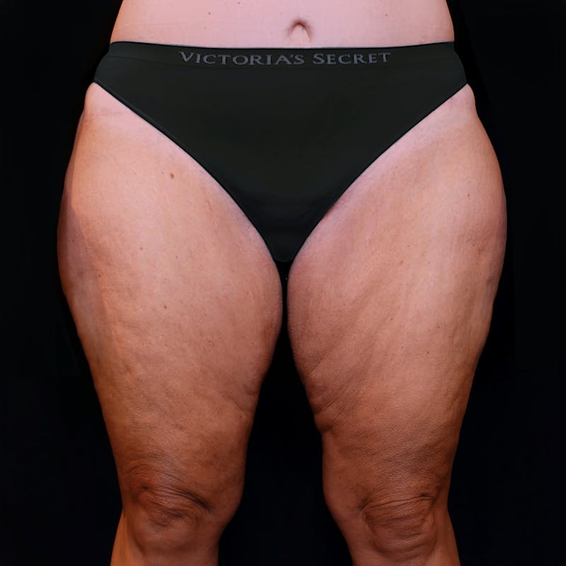 Before thighplasty