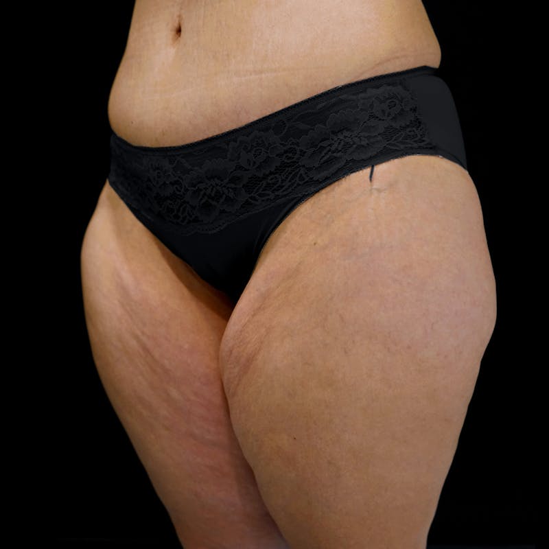 Thigh Lift Before & After Gallery - Patient 188372 - Image 3