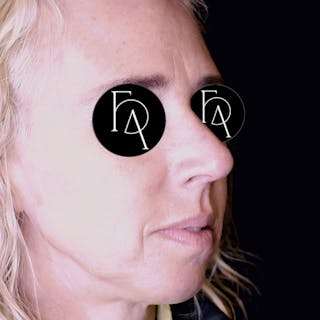 Rhinoplasty Before & After Gallery - Patient 120718 - Image 2