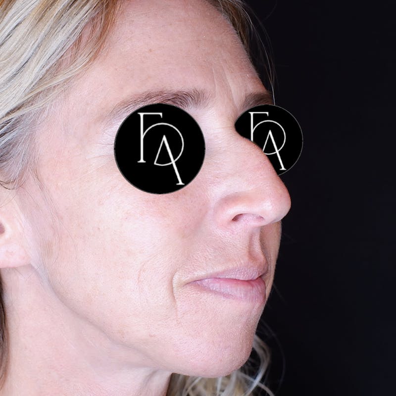Rhinoplasty Before & After Gallery - Patient 120718 - Image 1