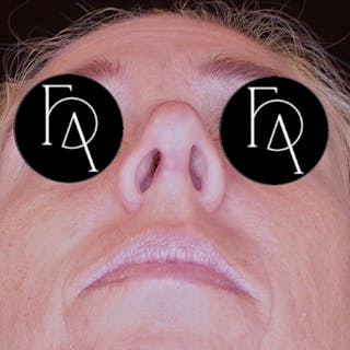 Rhinoplasty Before & After Gallery - Patient 120718 - Image 4