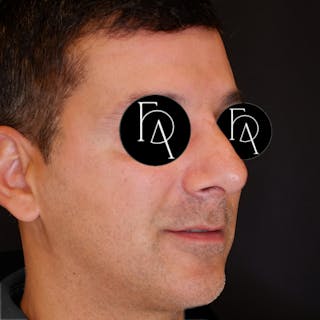 Rhinoplasty Before & After Gallery - Patient 354938 - Image 2