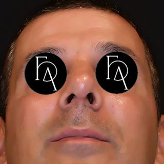 Rhinoplasty Before & After Gallery - Patient 354938 - Image 4