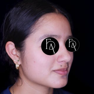 Rhinoplasty Before & After Gallery - Patient 240528 - Image 2