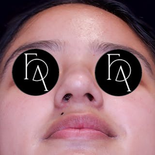 Rhinoplasty Before & After Gallery - Patient 240528 - Image 4