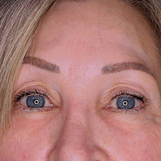 Undereye Laser Resurfacing Before & After Gallery - Patient 888640 - Image 2