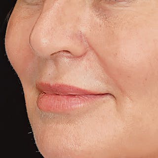 Undereye Laser Resurfacing Before & After Gallery - Patient 529264 - Image 4