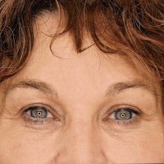 Undereye Laser Resurfacing Before & After Gallery - Patient 529264 - Image 2