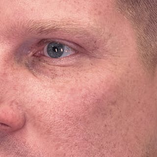 Undereye Laser Resurfacing Before & After Gallery - Patient 116973 - Image 4