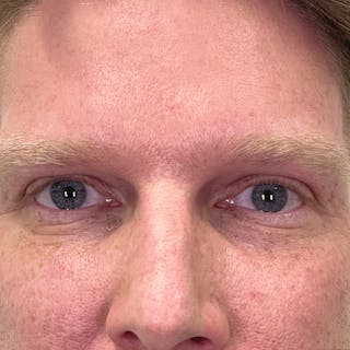 Undereye Laser Resurfacing Before & After Gallery - Patient 116973 - Image 2