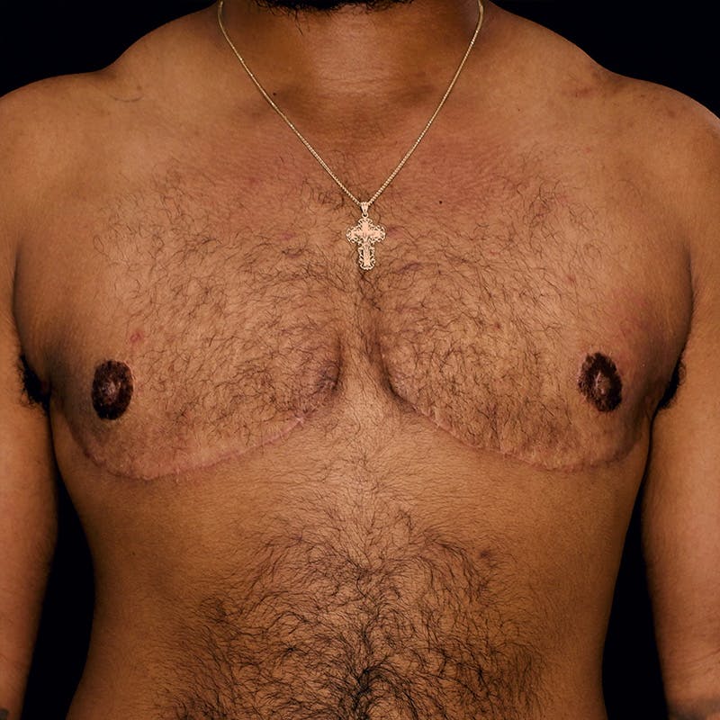 Gender Confirmation Breast Surgery Before & After Gallery - Patient 334121 - Image 2