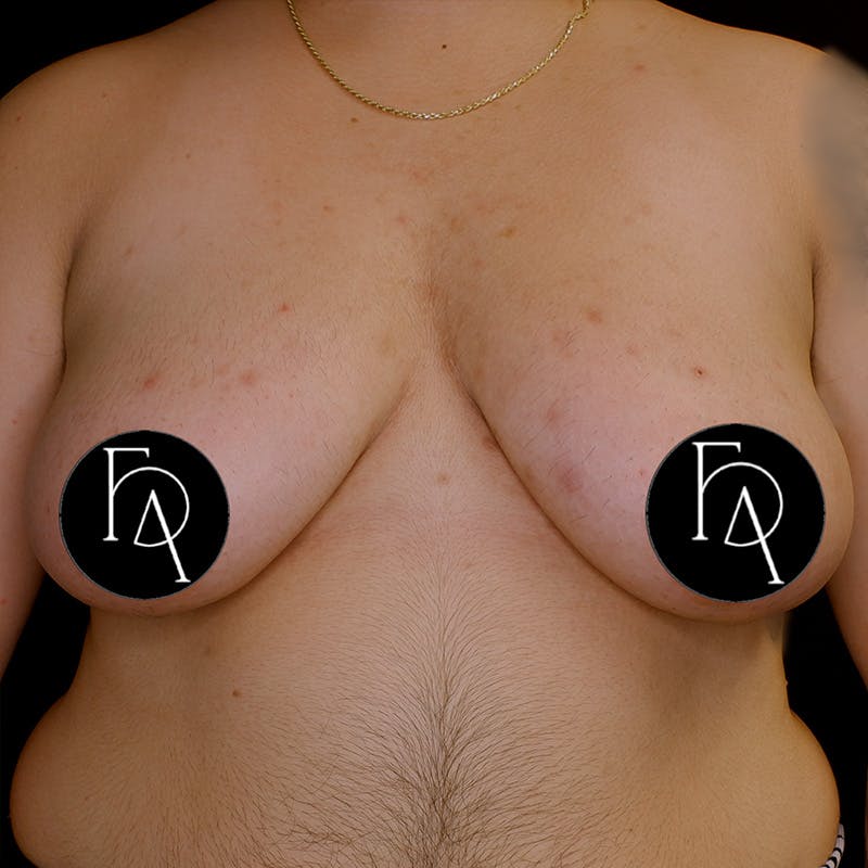 Gender Confirmation Breast Surgery Before & After Gallery - Patient 308187 - Image 1