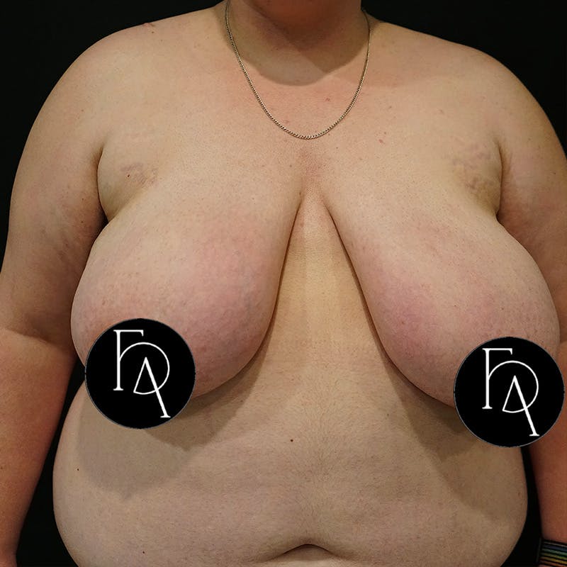 Gender Confirmation Breast Surgery Before & After Gallery - Patient 365418 - Image 1