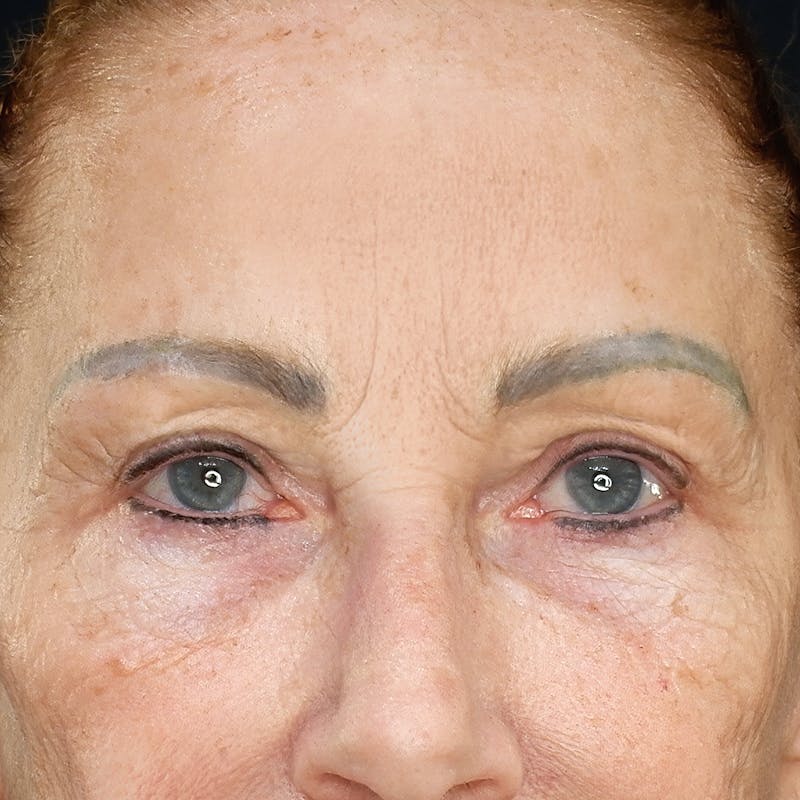 Before Browlift