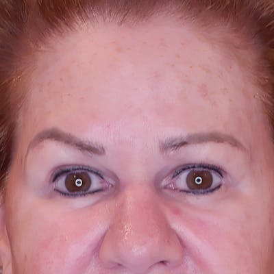 Brow Lift Before & After Gallery - Patient 830924 - Image 1