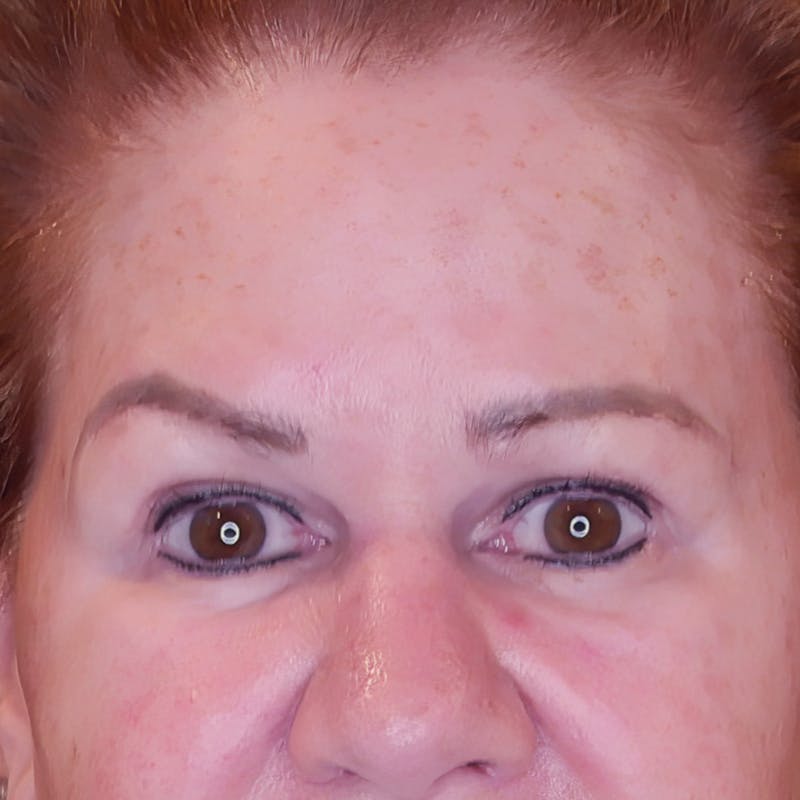 Brow Lift Before & After Gallery - Patient 830924 - Image 1