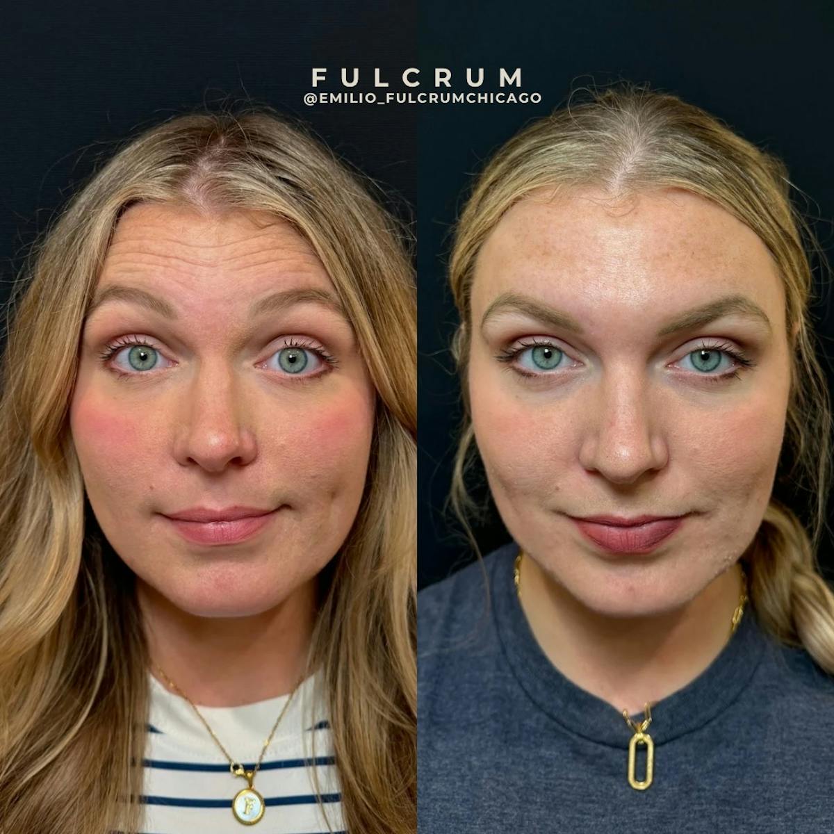Neuromodulators Before & After Gallery - Patient 216629 - Image 2