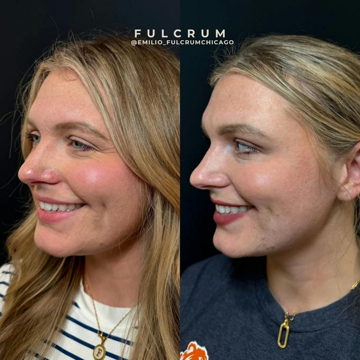 Neuromodulators Before & After Gallery - Patient 216629 - Image 3