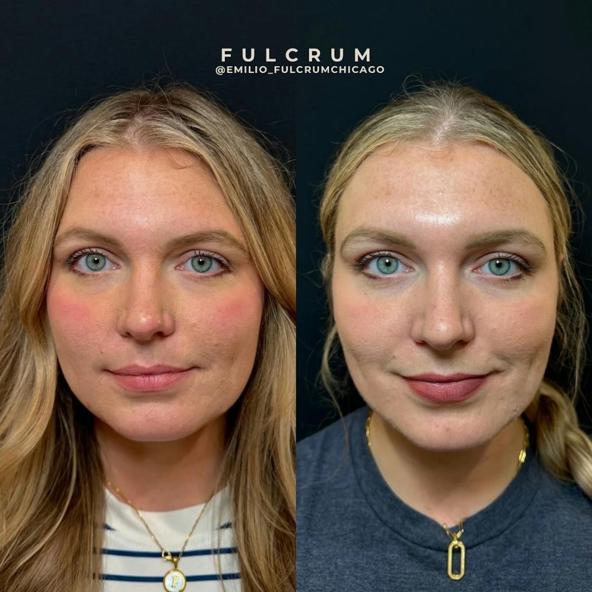Neuromodulators Before & After Gallery - Patient 216629 - Image 4