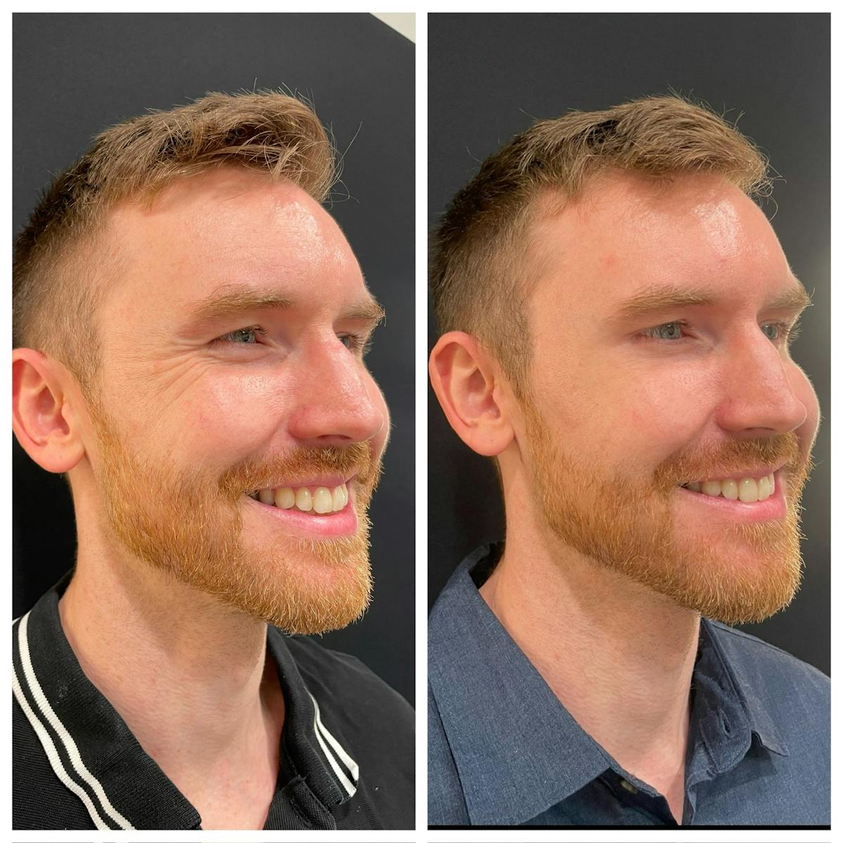 Neuromodulators Before & After Gallery - Patient 401753 - Image 2
