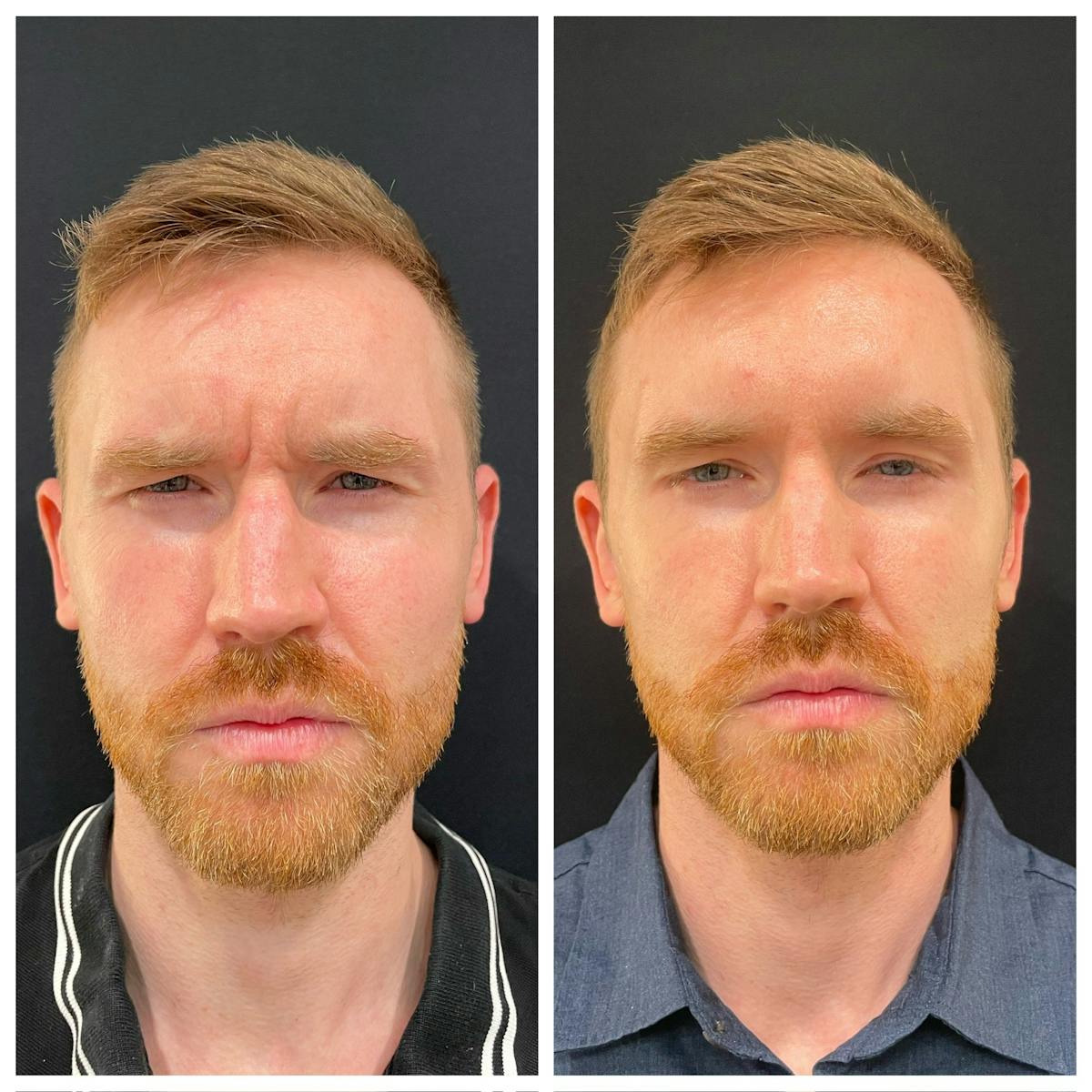 Neuromodulators Before & After Gallery - Patient 401753 - Image 1