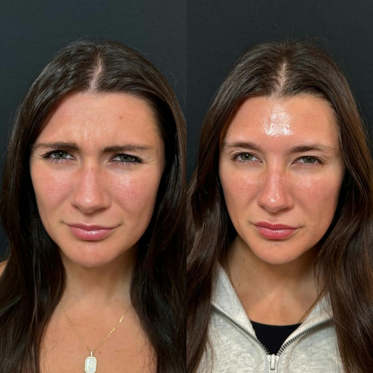 Neuromodulators Before & After Gallery - Patient 317111 - Image 1