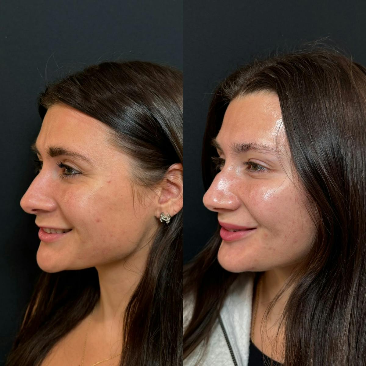 Neuromodulators Before & After Gallery - Patient 317111 - Image 3