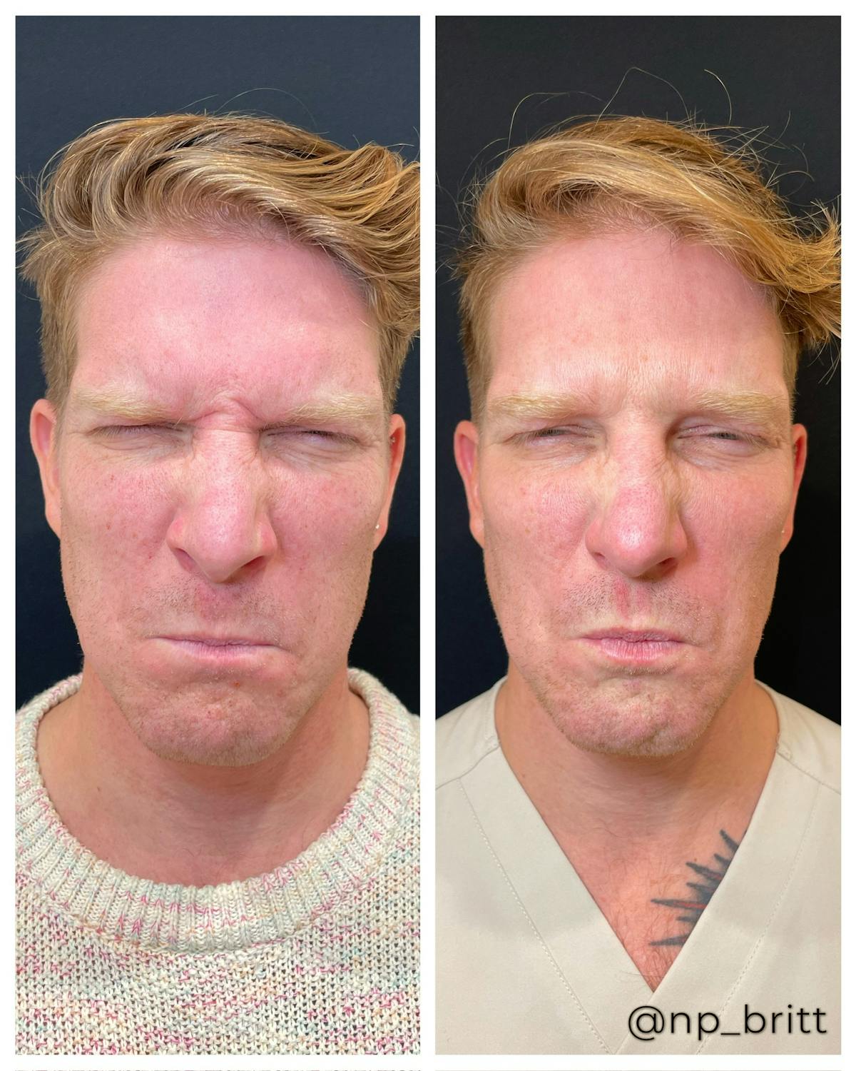 Neuromodulators Before & After Gallery - Patient 252626 - Image 1