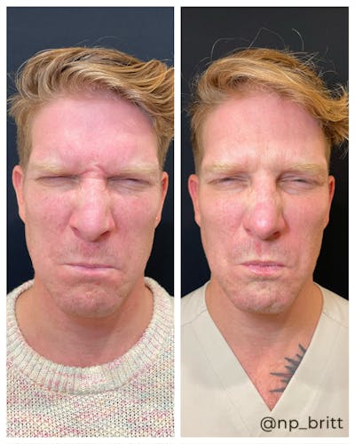 Neuromodulators Before & After Gallery - Patient 252626 - Image 1