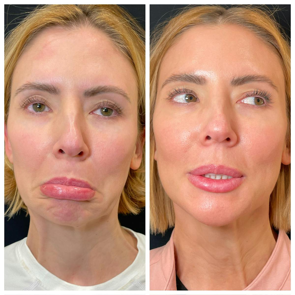 Neuromodulators Before & After Gallery - Patient 235012 - Image 1
