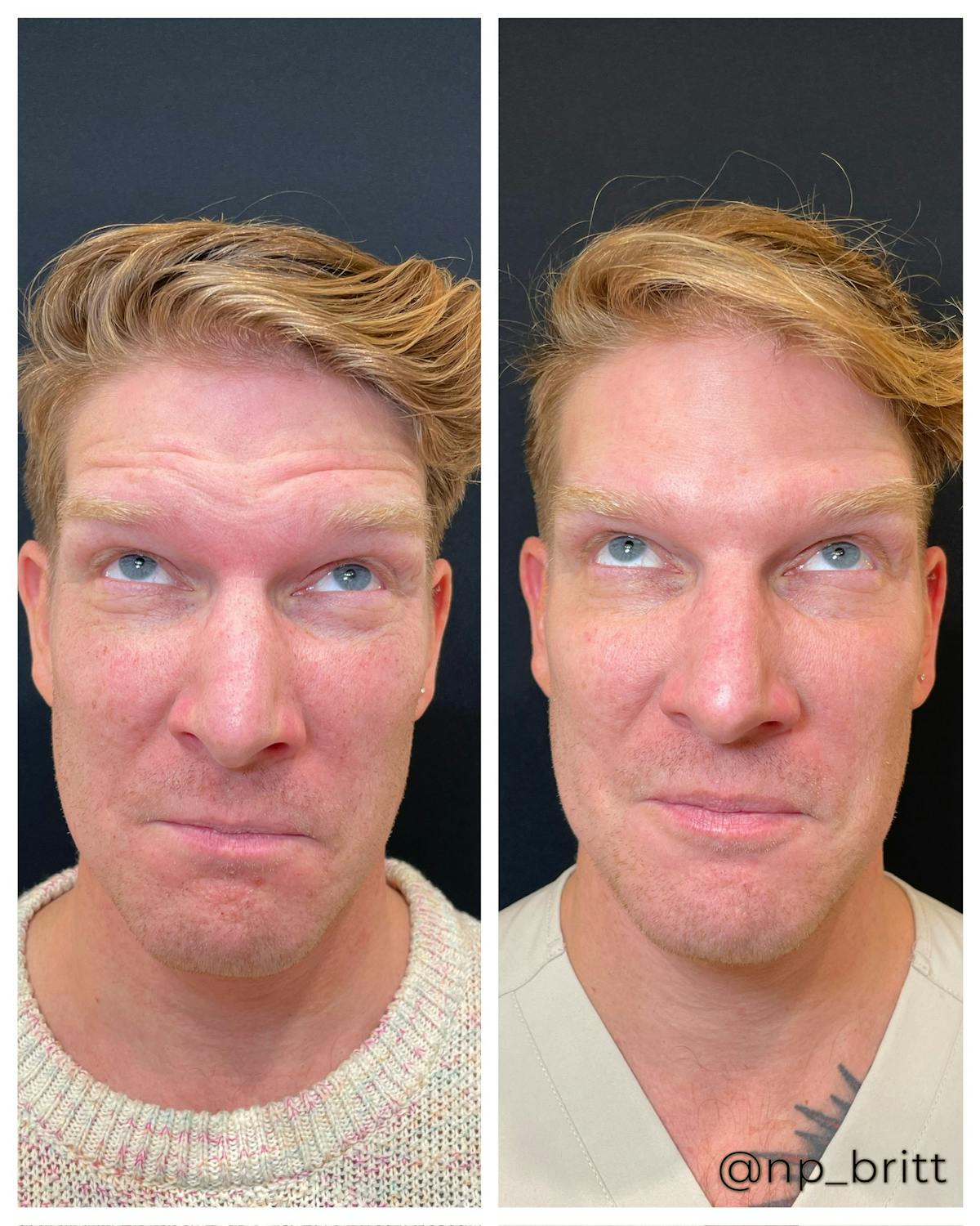 Neuromodulators Before & After Gallery - Patient 252626 - Image 2
