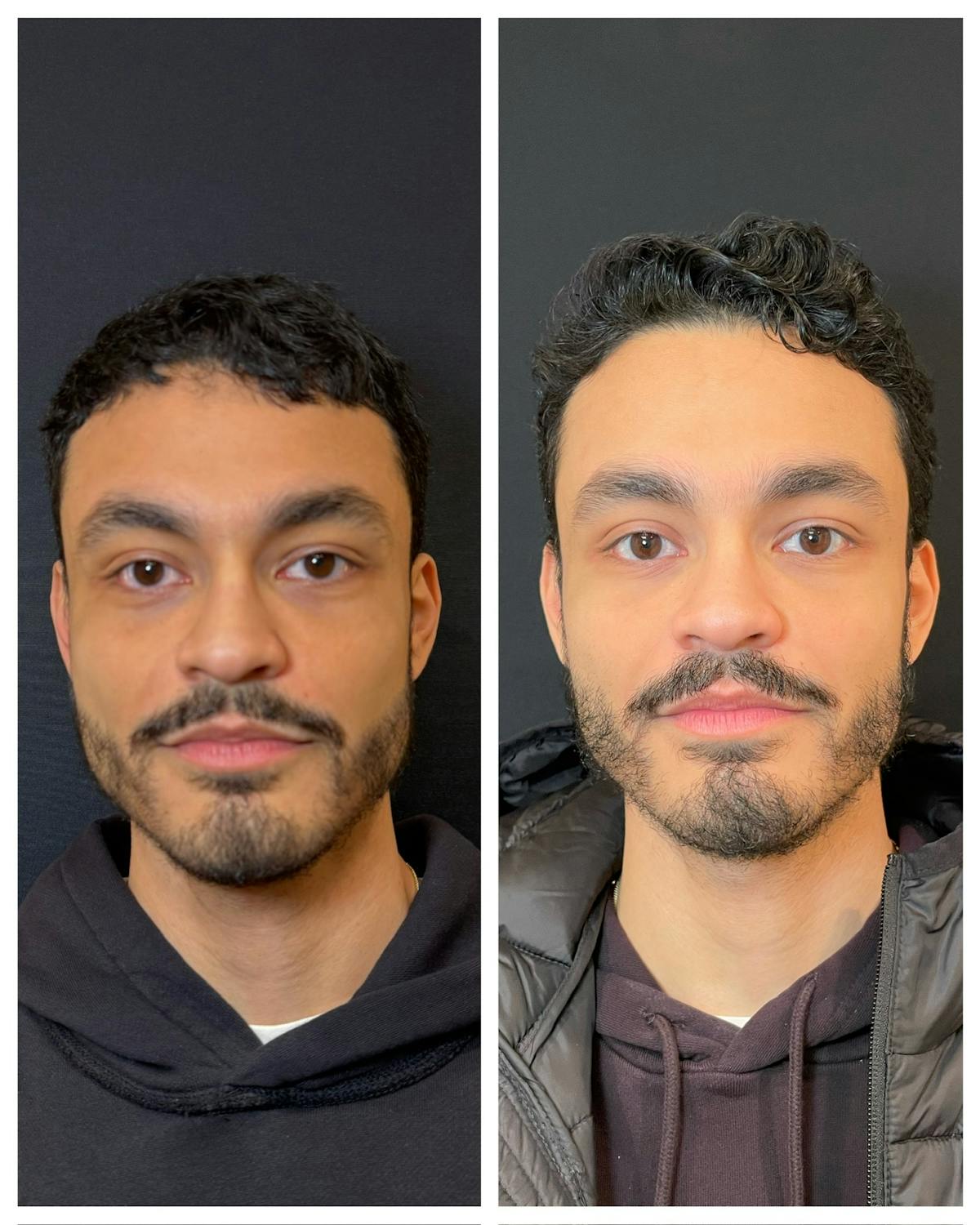 Neuromodulators Before & After Gallery - Patient 655195 - Image 2