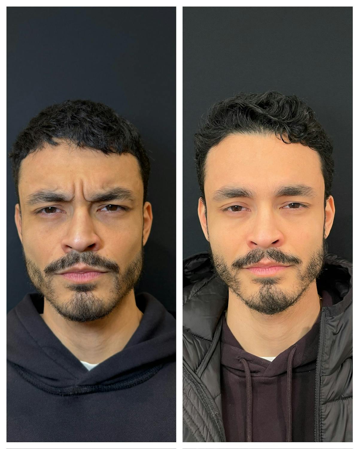 Neuromodulators Before & After Gallery - Patient 655195 - Image 1