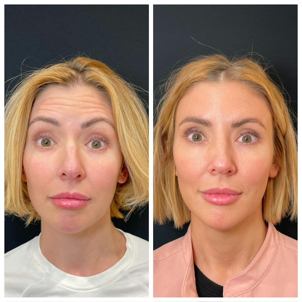 Neuromodulators Before & After Gallery - Patient 253735 - Image 2