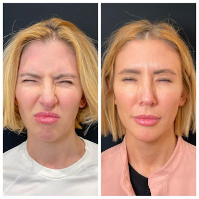 Neuromodulators Before & After Gallery - Patient 253735 - Image 1